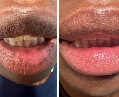 Nuvira™ Dark Lips Brightening Cream